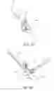 Fig. 17 - Minimally invasive total hip replacement