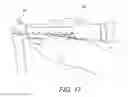Fig. 19 - Minimally invasive total hip replacement