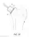 Fig. 25 - Minimally invasive total hip replacement