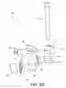 Fig. 28 - Minimally invasive total hip replacement