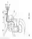 Fig. 11 - URETHRAL ANASTOMOSIS DEVICE