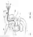 Fig. 12 - URETHRAL ANASTOMOSIS DEVICE