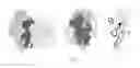 Fig. 03 - Method for treating psoriasis by administering an anti-IL-12 antibody