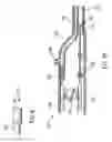 Fig. 08 - Device for controlled endoscopic penetration of injection needle
