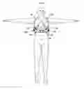 Fig. 05 - Method and apparatus for the nonsurgical correction of chest wall deformities