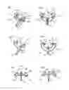 Fig. 02 - EYE MARKER FOR EYE SURGERY