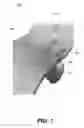 Fig. 02 - System and method for facet fixation