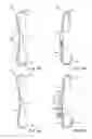 Fig. 06 - STRUCTURES AND METHODS FOR CONSTRAINING SPINAL PROCESSES WITH SINGLE CONNECTOR
