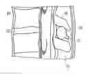 Fig. 01 - METHOD FOR DILATING BETWEEN SPINOUS PROCESSES
