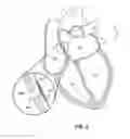 Fig. 06 - Systems and methods for reducing occurrences of atrial arrhythmias