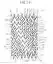 Fig. 12 - Stent and stent delivery system