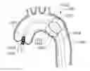Fig. 01 - STABILITY DEVICE FOR USE WITH PERCUTANEOUS DELIVERY SYSTEMS