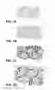 Fig. 02 - ORTHOPEDIC IMPLANTS HAVING GRADIENT POLYMER ALLOYS
