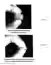 Fig. 02 - Process for demineralization of bone matrix with preservation of natural growth factors