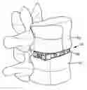Fig. 01 - Expandable interbody fusion implant