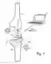 Fig. 02 - Prosthetic component having a compliant surface