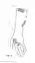 Fig. 09 - Orthopedic padding