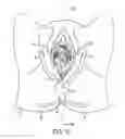 Fig. 13 - Method, Apparatus and System for Preventing or Reducing the Severity of Hemorroids