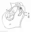 Fig. 14 - Method, Apparatus and System for Preventing or Reducing the Severity of Hemorroids