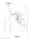 Fig. 02 - Medical Electrical Lead