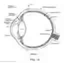 Fig. 02 - IMPLANTABLE OPHTHALMIC MEMS SENSOR DEVICES AND METHODS FOR EYE SURGERY