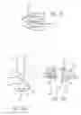 Fig. 08 - EXTRA-MEDULLARY CORTICAL BUTTRESS FIXATION DEVICE AND METHOD OF USE ASSOCIATED THEREWITH