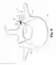 Fig. 06 - Fastener Element Retention Feature for Bone Anchors