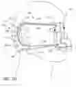 Fig. 08 - PATIENT INTERFACE ASSEMBLY WITH SIMULTANEOUS MASKSTRAP ADJUSTMENT