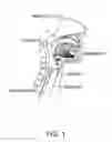 Fig. 02 - Methods and devices for treating sleep apnea and snoring