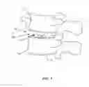 Fig. 02 - Surgical tool for adjusting a spinal implant