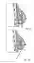 Fig. 18 - MINIMALLY INVASIVE TISSUE SUPPORT
