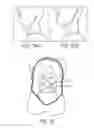 Fig. 24 - MINIMALLY INVASIVE TISSUE SUPPORT