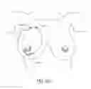 Fig. 70 - MINIMALLY INVASIVE TISSUE SUPPORT