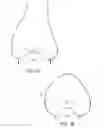 Fig. 02 - Patient-adapted and improved articular implants, designs and related guide tools