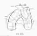Fig. 167 - Patient-adapted and improved articular implants, designs and related guide tools