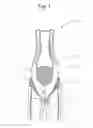 Fig. 02 - Sportswear to aid in pelvis support
