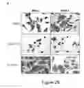 Fig. 04 - TREATMENT OF HUMAN OSTEOSARCOMA