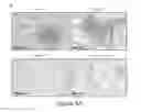 Fig. 16 - TREATMENT OF HUMAN OSTEOSARCOMA