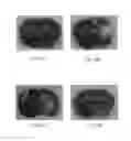 Fig. 02 - Drug Delivery Method Via Brain Extracellular Space and a Device Thereof