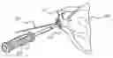 Fig. 01 - Combination driver/anti-rotation handle for shoulder arthroplasty