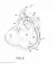 Fig. 07 - Patient-specific instruments for total ankle arthroplasty