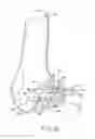 Fig. 09 - Patient-specific instruments for total ankle arthroplasty