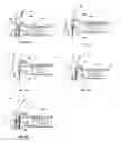 Fig. 15 - Methods of meniscus repair