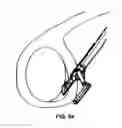 Fig. 30 - Methods of meniscus repair