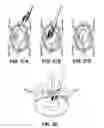 Fig. 34 - Methods of meniscus repair