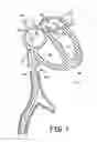 Fig. 02 - Transseptal Puncturing Device