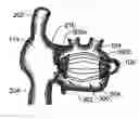 Fig. 01 - INTRACARDIAC CAGE AND METHOD OF DELIVERING SAME