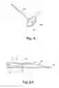 Fig. 07 - Removable localizing wire