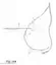 Fig. 09 - Removable localizing wire