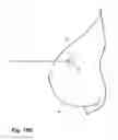 Fig. 10 - Removable localizing wire